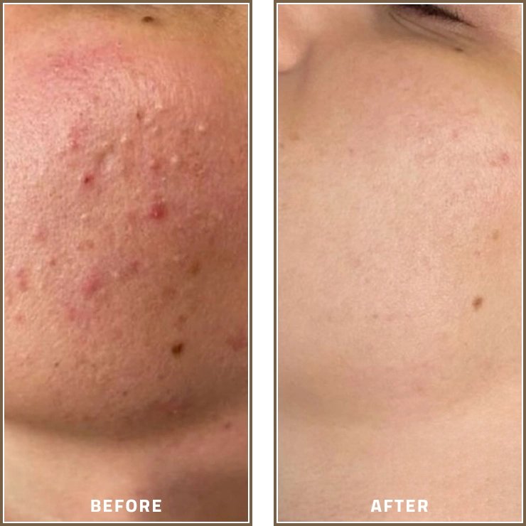 Acne Treatment Before and After Results for Clearer Skin