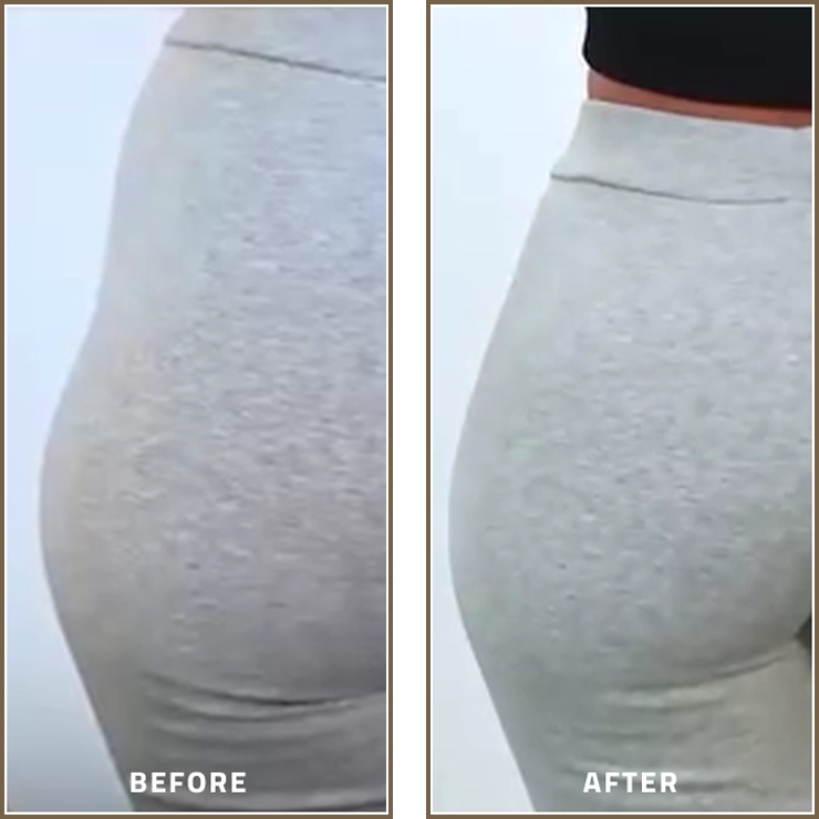 Body Filler Before and After Results for Enhanced Body Contouring