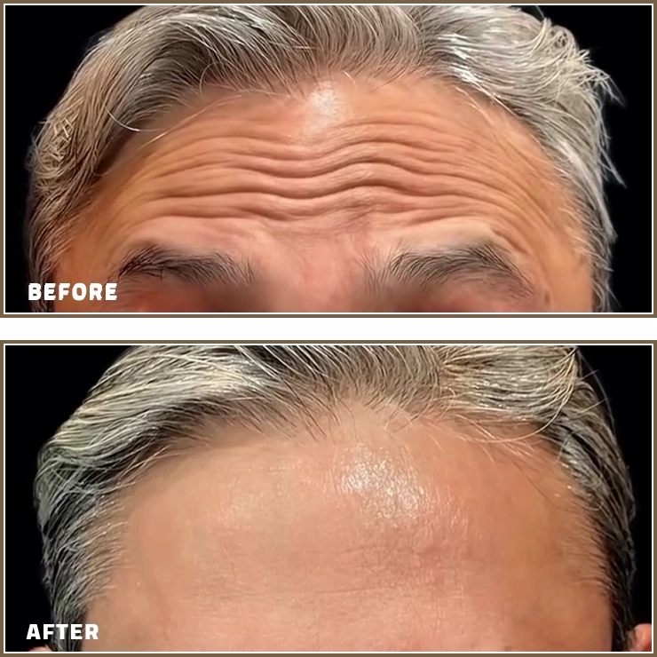 Forehead Botox