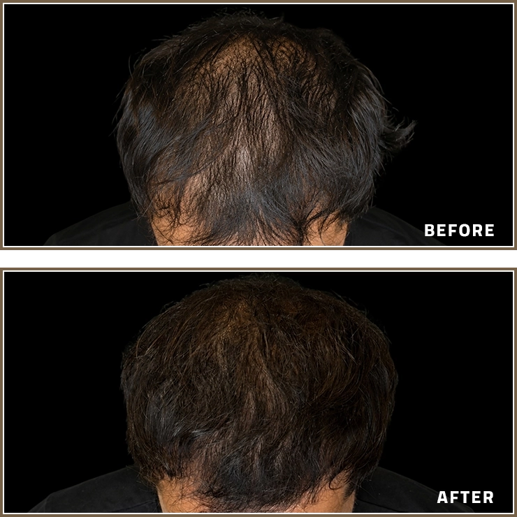 Hair Loss Treatment