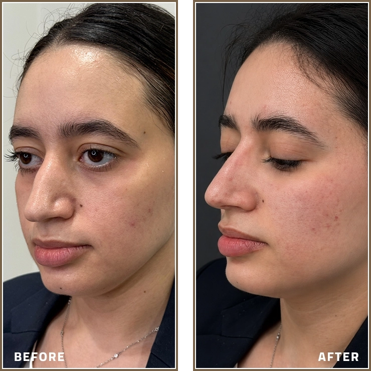 Under-Eye Booster and Nose Filler